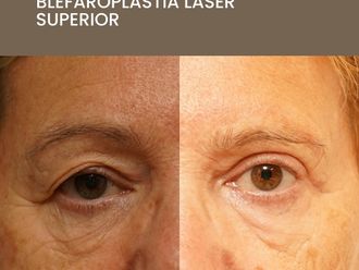 Blefaroplastia antes y después - 872572