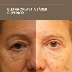 Blefaroplastia Láser Superior