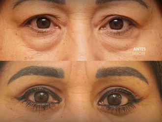 Blefaroplastia antes y después - 880411