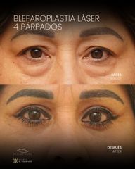 Blefaroplastia Láser 4 Párpados
