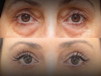 Blefaroplastia antes y después - 880412