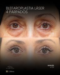 Blefaroplastia Láser 4 Párpados