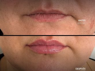 Aumento labios antes y después - 880501