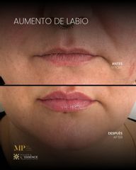 Aumento de Labios