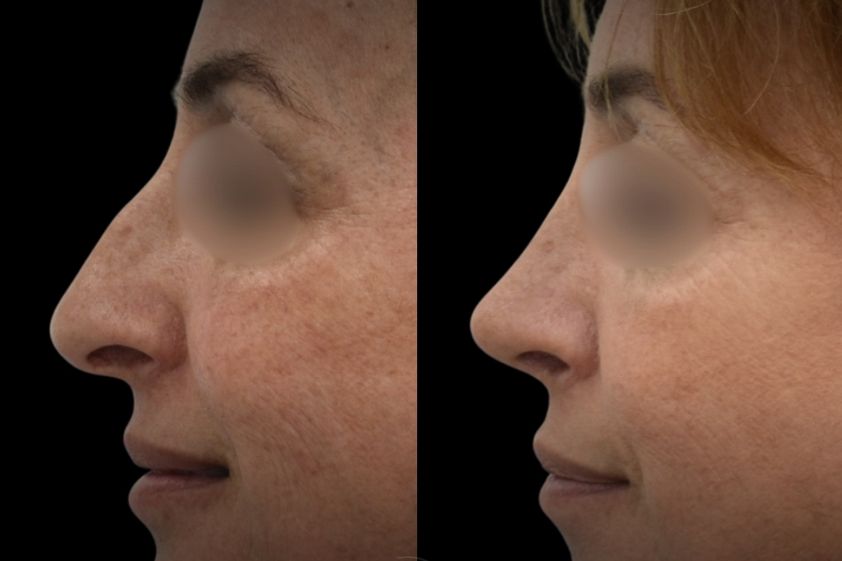 Rinoplastia antes y después - 880502