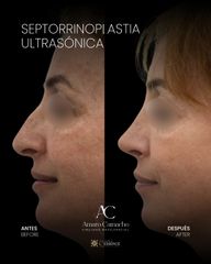 Septorrinoplastia Ultrasónica