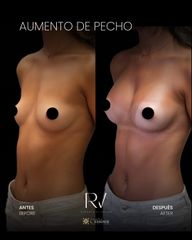 Antes/Después Aumento de Pecho - Clínica Villoria L'Essence