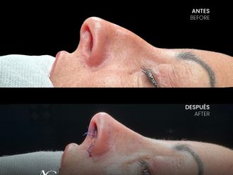 Rinoplastia antes y después - 881166