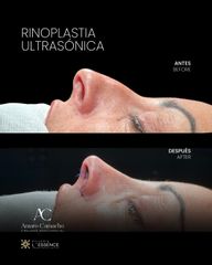 Antes/Depués - Clínica Villoria L'Essence