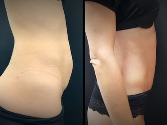 Abdominoplastia antes y después - 881167