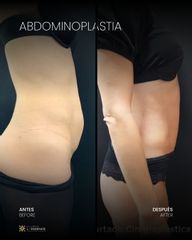 A/D Abdominoplastia - Clínica Villoria L'Essence