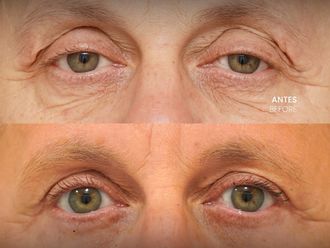 Blefaroplastia antes y después - 881168