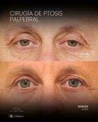 A/D Blefaroplastia - Clínica Villoria L'Essence