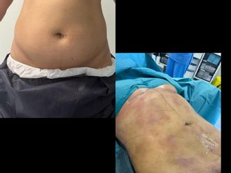 Lipoláser antes y después - 846632