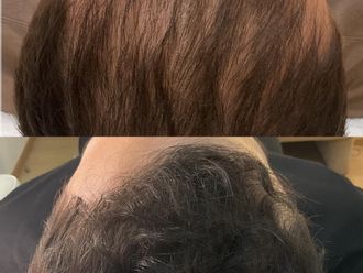 Mesoterapia capilar antes y después - 879349