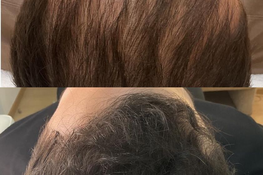 Mesoterapia capilar antes y después - 879349