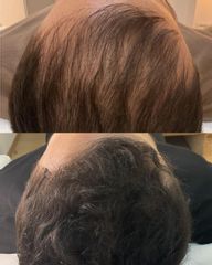 MESOTERAPIA CAPILAR