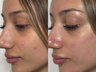 Microneedling antes y después - 879352