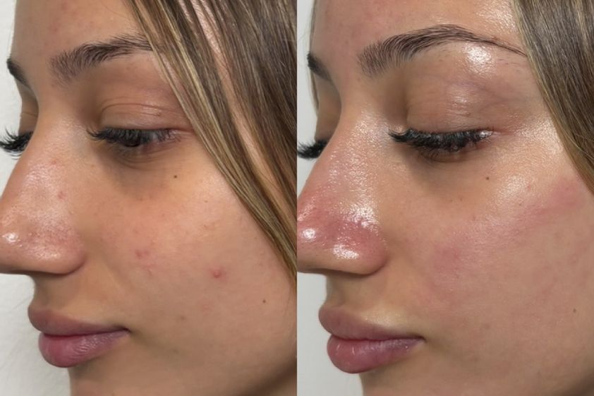 Microneedling antes y después - 879352
