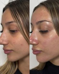 DERMAPEN CON CENTELLA ASIATICA
