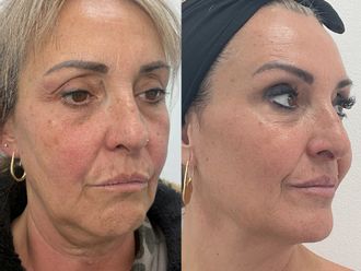Rellenos faciales antes y después - 879426