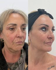 SCULPTRA