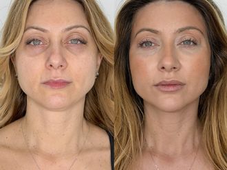 Eliminación ojeras antes y después - 879427