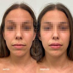 Aumento de labios - Clínica Cemo
