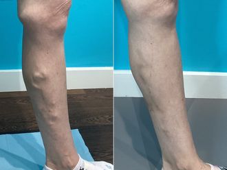 Tratamiento varices antes y después - 870085