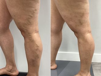 Tratamiento varices antes y después - 870086