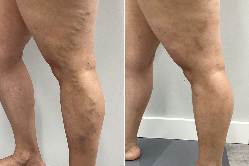 Tratamiento varices antes y después - 870086