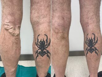 Tratamiento varices antes y después - 870089