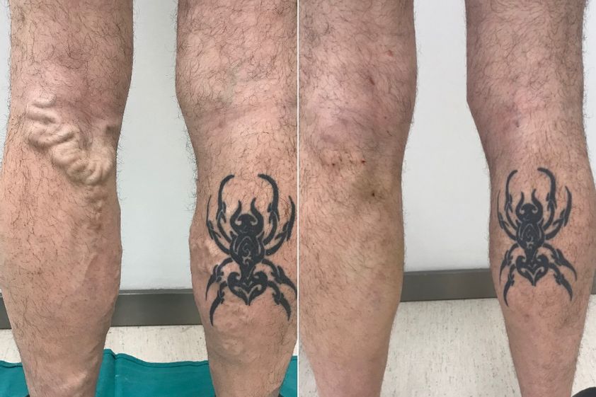 Tratamiento varices antes y después - 870089