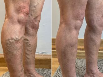 Tratamiento varices antes y después - 870090