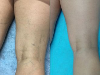 Tratamiento varices antes y después - 870091