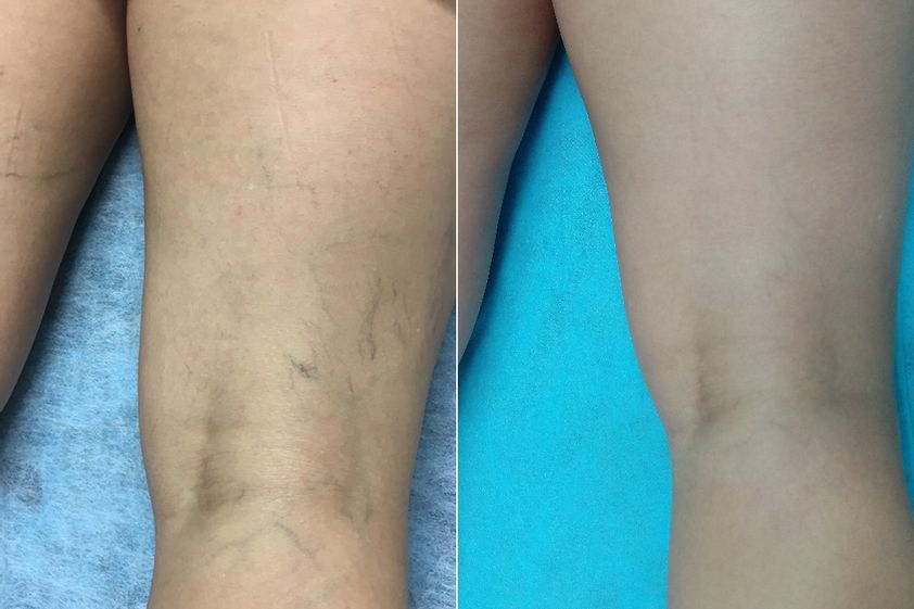 Tratamiento varices antes y después - 870091