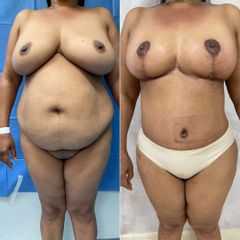 Abdominoplastia