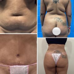 Abdominoplastia