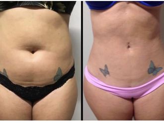 Liposucción antes y después - 878765