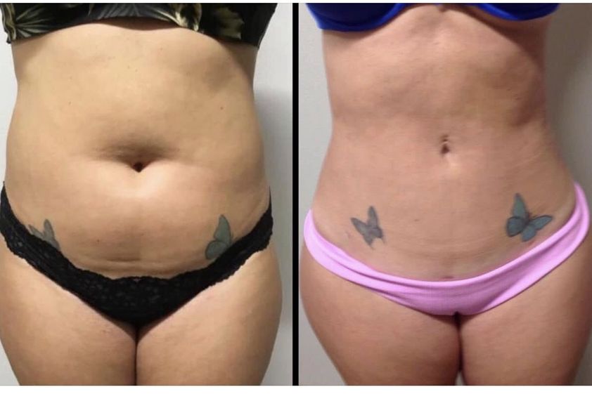 Liposucción antes y después - 878765