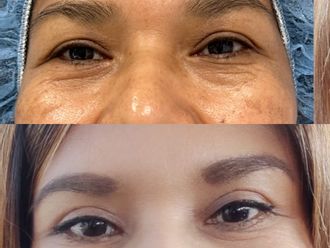 Blefaroplastia antes y después - 878766