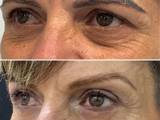 Blefaroplastia antes y después - 878767