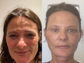 Lifting antes y después - 878768