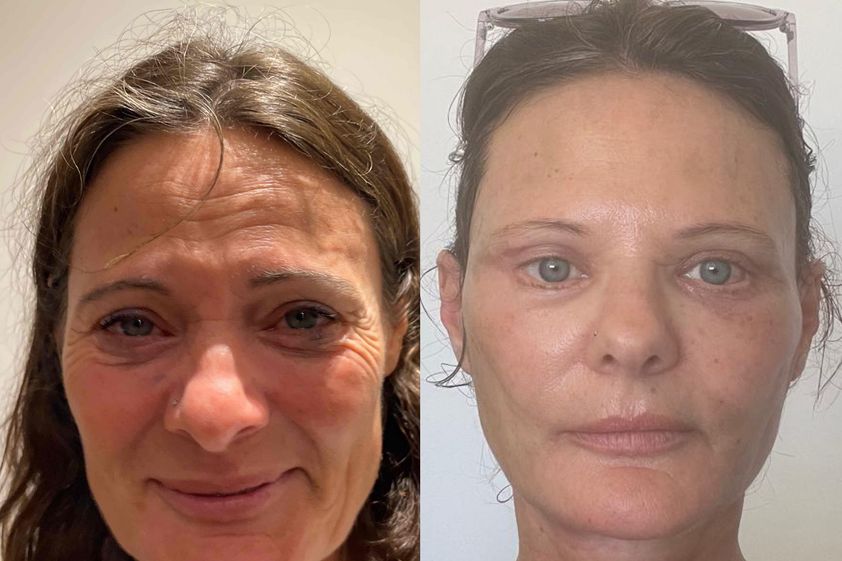 Lifting antes y después - 878768