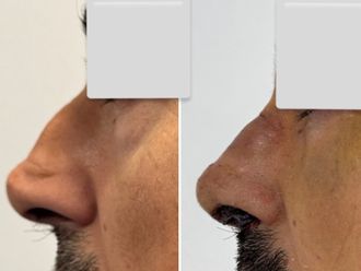 Rinoplastia antes y después - 878770