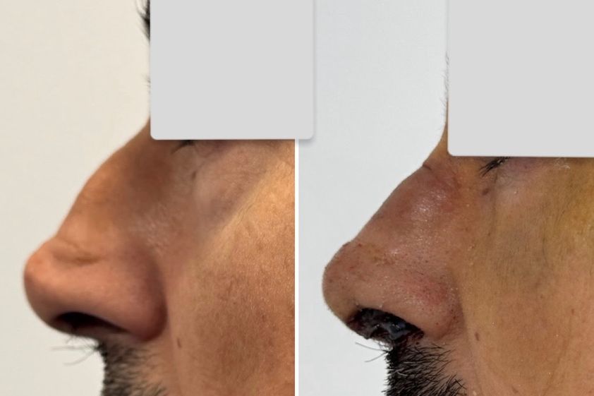 Rinoplastia antes y después - 878770