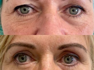 Blefaroplastia antes y después - 878772