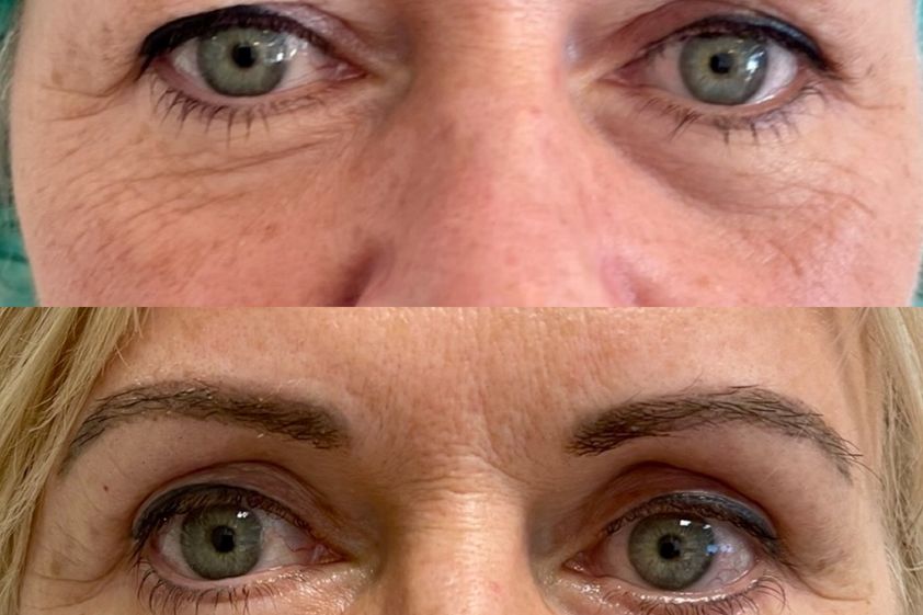 Blefaroplastia antes y después - 878772