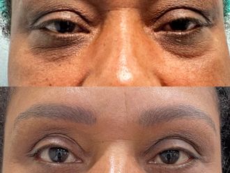 Blefaroplastia antes y después - 878797