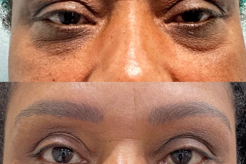 Blefaroplastia antes y después - 878797